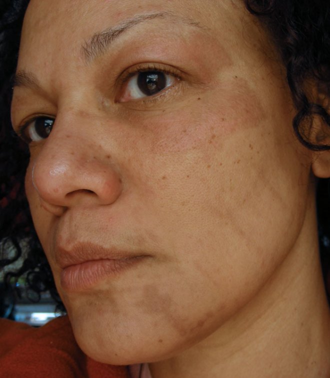 now this is what i'm left with, 3 weeks post peel