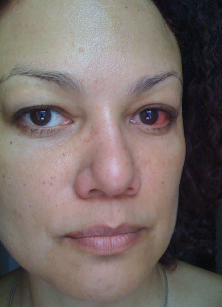 the damage i did rummaging in my eye for my lense last night